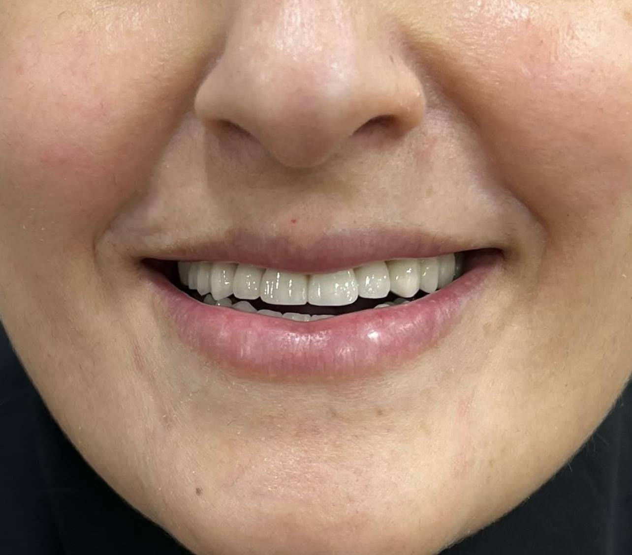 ابتسامة  ساحره وثقة مضاعفه 🩵🔥 عيادتنا فرع حي النصر 🔥🔥

تعويض الاسنان باستخدام (اسنان الزاركون  ألالماني) لمراجعتنا من حي النصر 
وتم تعويضها ب اسنان وابتسامة مشرقة💯
على يد الطبيب الاختصاص
د.محمد منصور 
(ماجستير في طب ومعالجة الاسنان) 

أبتسامتك ~ يم عيادات الفرح لطب وتجميل الأسنان ~ غير ✨😍

علماً كافة الابتسامات والحشوات مع ضمان مدى الحياة 😎

📍 #العنوان :- حي النصر/ شارع السوق / خلف جامع الأمام المهدي/فوق صيدلية مصطفى جاسم أو اسواق الزعيم 

للإتصال 📞📞 
فرع حي النصر
للحجز والاستفسار 👇

*********** ☎️

دوام العياده ⏰
فرع حي النصر 
من الساعه 5  عصرا 
إلى 
الساعه 10 مساءا
#هوليوود #سمايل #حي #النصر #عيادة #الفرح #تغليف #ايماكس #زاركون #بغداد #ابتسامة #حشوات #زراعه #تقويم
