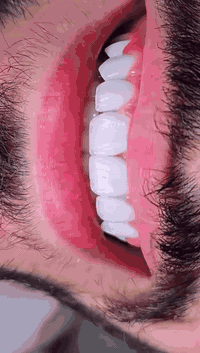 ابتسامة واثقة صنعت بأتقان على يد امهر الاطباء من مركز اوتار كلنك لطب الأسنان والتجميل 
العنوان الشموخ خلف مكتب الحنين للعقار داخل الفرع 
للحجز الاتصال على الرقم 
***********
                 https://www.instagram.com/p/DP_hUuQjKPC/?igsh=aTZwbW1nMmFoNW11
