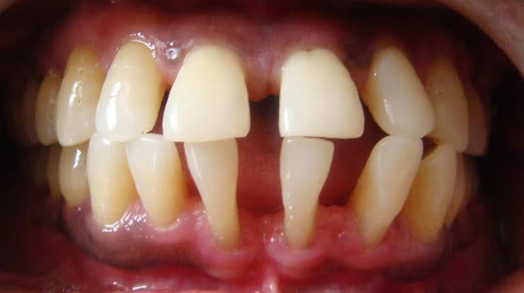 سلام عليكم يتوفر قلع جذور الاسنان واسنان متحركة واسنان لبنية واستبدالها بطقم متحرك تواصل خاص او واتساب رقم***********
