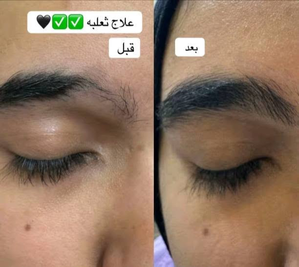 ✨منتجات والعلاج طبيعي شركة ليدورا العالميه✔️✨
♦مع الضمان لكل المنتجات والعلاج الطبيعي♦

منتجات عناية من شركة ليدورا العالميه 
منتج شعر يتكون من 5قطع علاج مضمون
💯💯
علاج كلف نمش تصبقات 
علاج تعرق الجسم 
علاج تشققات لاقدام 
علاج خشونه اليد 
علاج الجسم من جلد الوزه 
علاج براند طبيعي 
حصرن يتوفر بس يمنه 😍
من شركه عالميه عشبيه

1_للتجميل+العناية_للجسم وشعر الوجه كافة ✨

2_كل الحالات يشوفهة اخصائي او مستشار خاص للجلد وبشرة والشعر والجسم 

3_اعطاء علاج المناسب لكل حالة نستطيع علاجها- ولاكن العلاج يكون للمشاكل الخارجية فقط وليس المشاكل الداخليه 🔴

4_يتم متابعة الزبون ع مدار 4اسابيع او اكثر حتي يتم العلاج النهائي لحالة الشخص 

5_كل سبوع يوجد نادي للعملاء الي مسوقين من عدنة سابقا_واذا عدهم اي سؤال او استفسار يخص حالة معينة عدهم او اشخاص اخرين عادي جدا🔴
لذالك كل سبوع يوجد مستشار بشرة وشعر التشخيص مجانا يكون لديهم✅
 

🔴لدينا مستشارين ومستشارات خاصين للنساء والرجال🔴
    🔺يوجد توصيل لكل مناطق الكوت
#مكانه واسط_الكوت//#رقم_الهاتف: ***********
