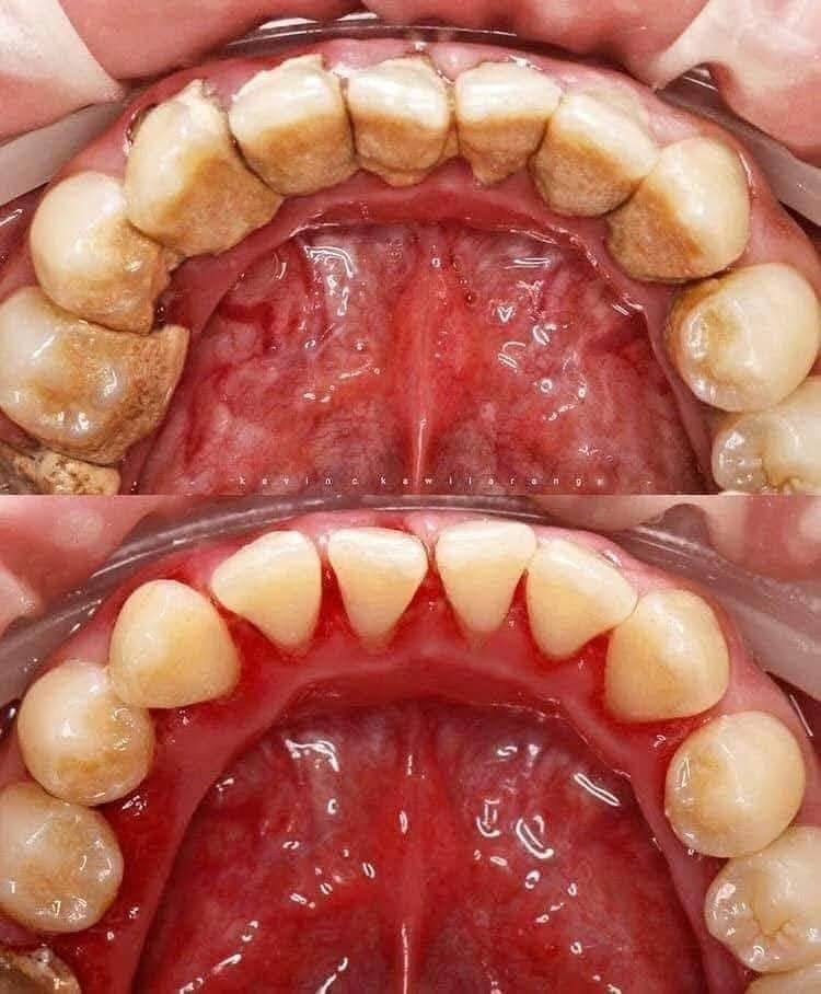 مجانا مجانا مجانا 
تعلن عيادات الصفوة الجامعه عن توفير خدمات مجانية 
_قلع الأسنان التالفه والجذور المتبقيه 
_تنظيف الأسنان وإزاله التكلسات 
_تعويض الأسنان بطقم متحرك 
_حشوات تجميلية 
المواعيد الأحد والثلاثاء 
للحجز مراسله الصفحة أو المراسلة ع الواتساب فقط ***********
كربلاء -حي النقيب - مقابل مطعم ناز
