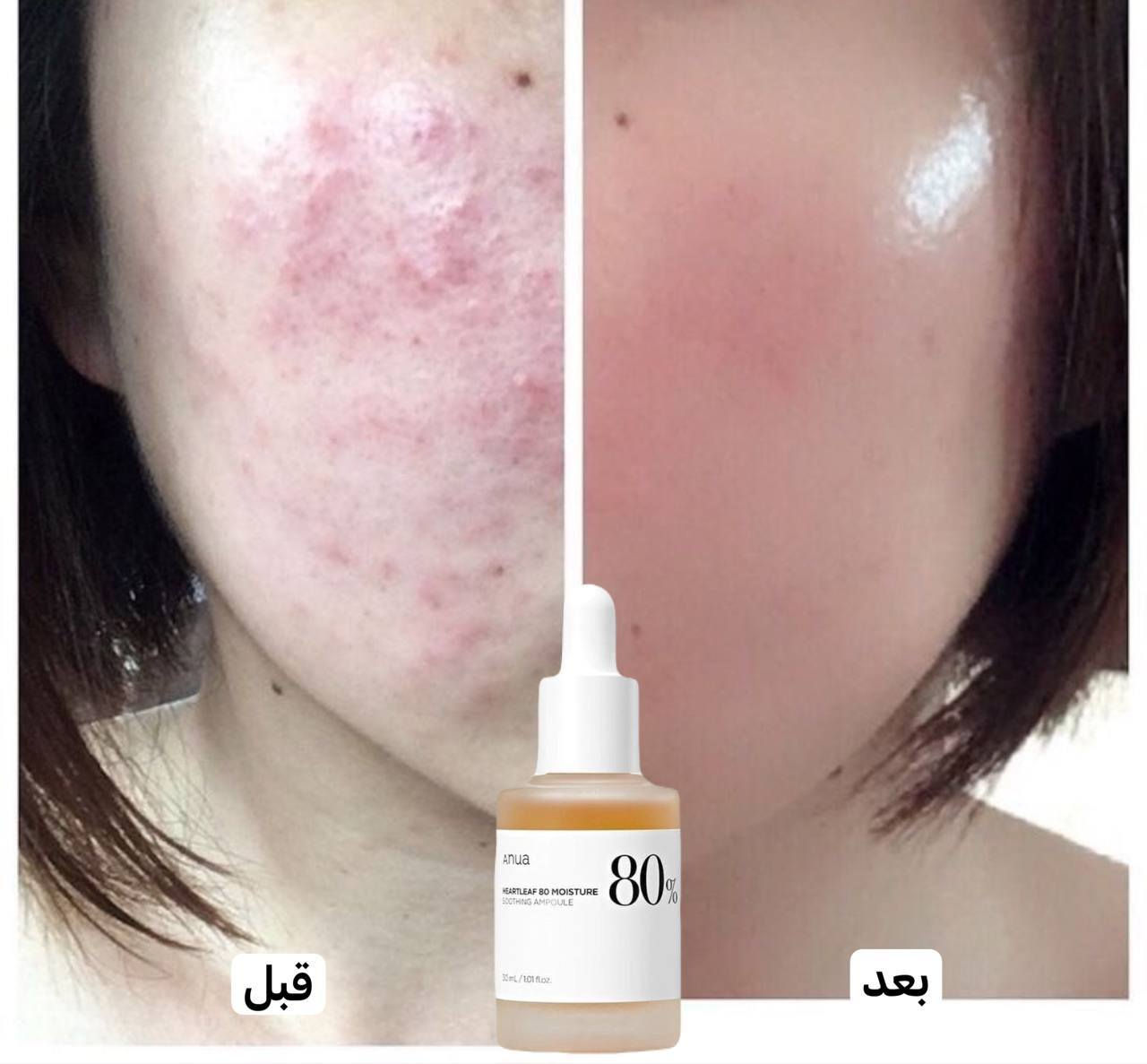 Anua Heartleaf 80% Moisture Soothing 🇰🇷🇰🇷🇰🇷
هو سيروم مرطب يهدئ البشرة وينظم الدهون بمكونات تحتوي على ما يصل إلى 80% من مستخلص نعناع السمك. مكون حميد مناسب جدًا للبشرة الفيتنامية لما له من خصائص تجديدية وترميمية، كما أنه يمنع ظهور حب الشباب الجديد ويهدئ حب الشباب القديم، لذلك فهو يمتلك القدرة على تهدئة البشرة، مما يساعد على تهدئة ندبات حب الشباب الملتهبة بسرعة.
تحتوي على البانثينول وحمض الهيالورونيك والبيتين للمساعدة في توفير الرطوبة وتحسين البشرة الجافة والمجففة واستعادة حاجز الجلد.

- إلى جانب ذلك، فهو يساعد أيضًا على تهدئة وتقليل الاحمرار وتقليل تورم حب الشباب وتثبيط البكتيريا وتنظيم الدهون وترطيب وتوازن درجة حموضة البشرة وتنقية البشرة.

80% Moisture Soothing Ampoule  يدعم استعادة الجلد بشكل أسرع بعد علاج الجلد وإزالة حب الشباب.. 

#الاصلي المنشأ كوريا 🇰🇷💯

🚘#يوجد #خدمة #توصيل #لجميع #محافظات #العراق  🚘


**إذا كنت صاحب هذا الإعلان وتريد حذفه لأي سبب، رجاءا أرسل رسالة إلى الدعم الفني**