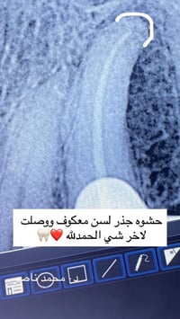 حشوات جذور • العازل المطاطي • حلة الامام علي