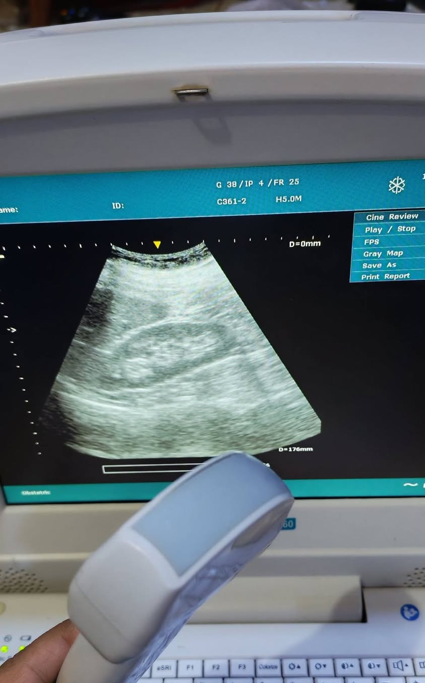 (( جهاز سونار للبيع ))
- جهاز سونار نوع Edan Dus60 مستعمل وبسعر مناسب جدا ...
 & اطبائنا الكرام &
- يوجد لدينا جهاز سونار مستعمل :-
اسم الجهاز :  Edan Dus60
سنة الصنع : 2020
المنشا : الماني
الملحقات : بروب convex 
نوع الجهاز : دوبلر  PW يحتوي على دوبلر 
مع جميع فحوصات
حالة الجهاز : ممتاز
وضوح الصورة : ممتاز
- للحجز والاستفسار يرجى مراسلة الصفحة او الاتصال على الرقم التالي :-
***********
وبسعر جدا جدا مناسب 💥💥

#أجهزةطبيةمستعملة #أجهزةسونار #سونار #اجهزةطبية #سونارمستعمل #سونارات #سامسونك #اجهزةطبيةجدبدة #اشعة #اشعةوسونار #اطباءسونار #سونرات #مهندس #sonoace #مستلزمات #طبية #فيلد #جل #كونفكس #فجاينل #لينير #4D #ob #gyn #abdomin #ايكو
#adaltecho #exam #GE #volusionp8
