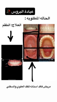 طقم فك كامل • فك علوي • فك سفلي