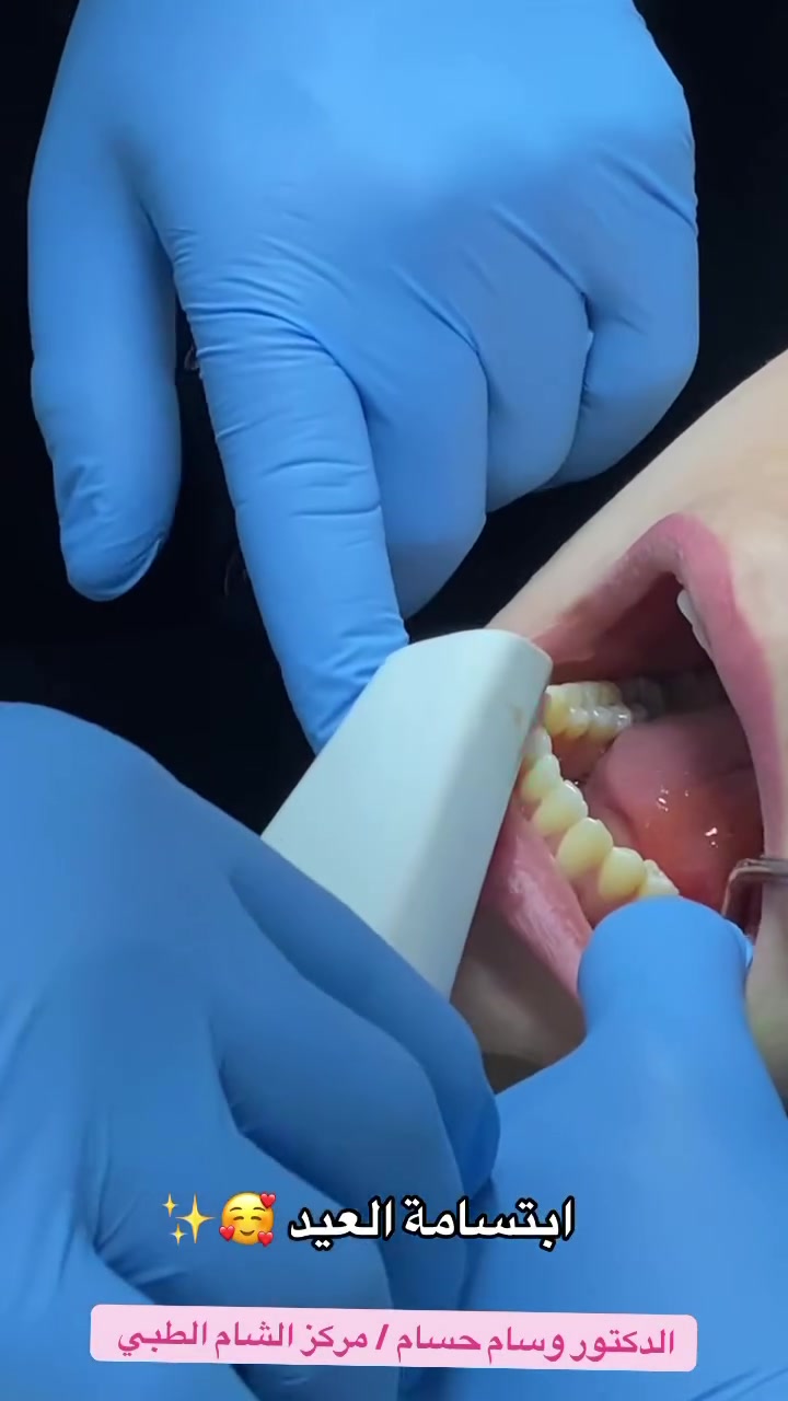 تغليف أسنان زيركون بإتقان د. وسام  
شغل احترافي بعيادة تجميل الأسنان ✨
🦷
باستخدام أحدث تقنيات الطباعة الرقمية

مركز الشام الطبي / قضاء الحي 
***********
