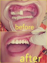 مرحبا اني دكتورة شهد  الشخص اللي عنده اسنان مفقوده ويريد يعوضها بطقم ي...