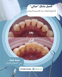 تنظيف أسنان • إزالة تكلسات • عيادات الجامعة