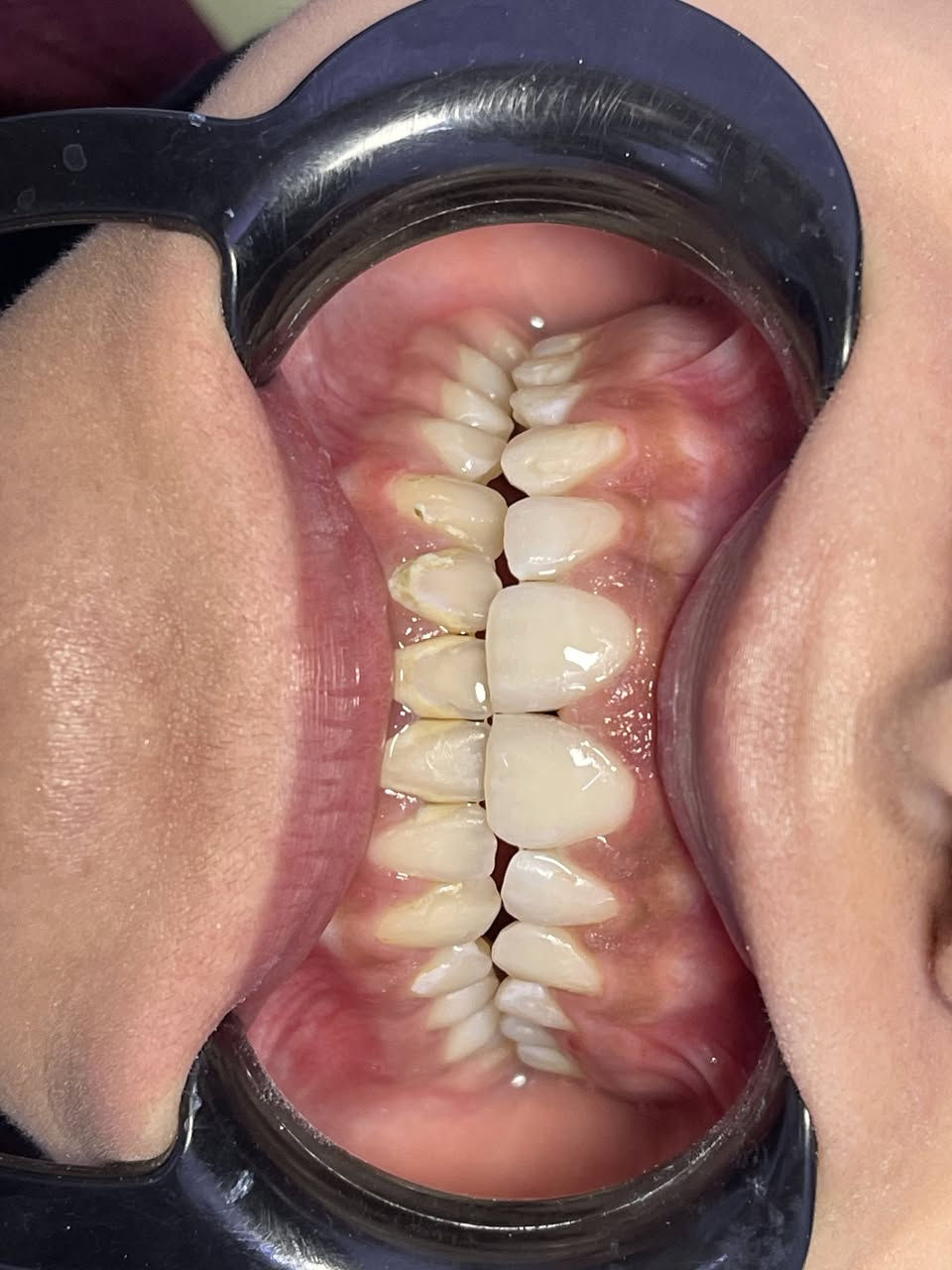 إغلاق الفراغ بين القواطع الامامية 
بيد الدكتورة طيبه علاء الزبيدي 
بكلوريوس طب وجراحة الفم والأسنان 
معيدة في الجامعة المستنصرية

نستقبلكم بكل حب يومياً من الساعة 5 إلى الساعة 10

العنوان #الطوبجي_مقابل_كوكتيل_البركة

لتثبيت حجوزاتكم يرجى الاتصال على الرقم ***********
