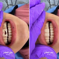 علاج تسوس • جلسة وحدة • بدرة