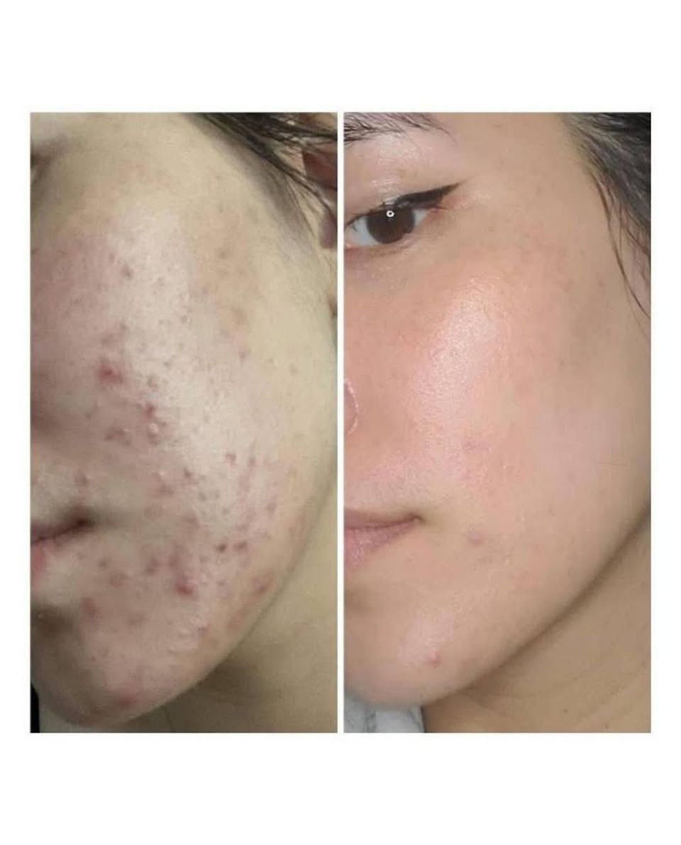 💚مجموعة المعجزة (AHA BHA PHA 30 Days Miracle AC SOS Kit) من العلامة التجارية الكورية سوم باي مي (SOME BY MI). صُممت خصيصاً كروتين متكامل للعناية بالبشرة المعرضة لحب الشباب والمشاكل الجلدية، حيث تعتمد على ثلاثة أنواع من أحماض التقشير (AHA و BHA و PHA) لتنظيف المسام وتجديد خلايا الجلد. 

السعر ١٨ الف


**إذا كنت صاحب هذا الإعلان وتريد حذفه لأي سبب، رجاءا أرسل رسالة إلى الدعم الفني**