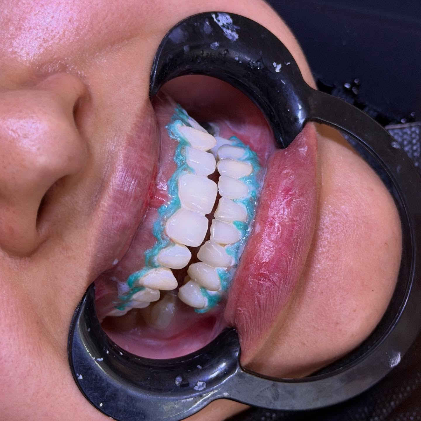 ⁨ شوفو جلسة التبييض 🦷😍 الدكتورة بتول عمار المرمضي 
📍📍عيادة بيرلي (نبتون)
الحمزة الشرقي جهة شارع الملاحة مقابيل صيدلية نجلاء الشيباني 
واتساب او الاستفسار ***********
#الحمزة_الشرقي #الديوانية #الحمزه_الشرقي #عيادة_بيرلي_نبتون #فلر_شفايف #فلرشفة_فلر_وجنات_فلرخطوط_ضاحكة_فلرذقن_تكساس_تكنيك❤️❤️❤️⁩⁩
