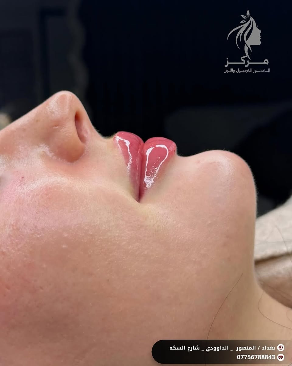 ✨ حقن فلر الشفاه
لشفاه ناعمة، ممتلئة وطبيعية 💋
🌸 تحديد شكل الشفاه بدقة
🌸 امتلاء طبيعي بدون تكتل
🌸 نتائج فورية وآمنة
مع الدكتورة مروه عادل كاظم 👩‍⚕️
📞 للحجز والاستفسار:
***********
📍 العنوان:
بغداد – المنصور – الداودي
مستشفى المنصور الجراحي – الطابق الرابع
