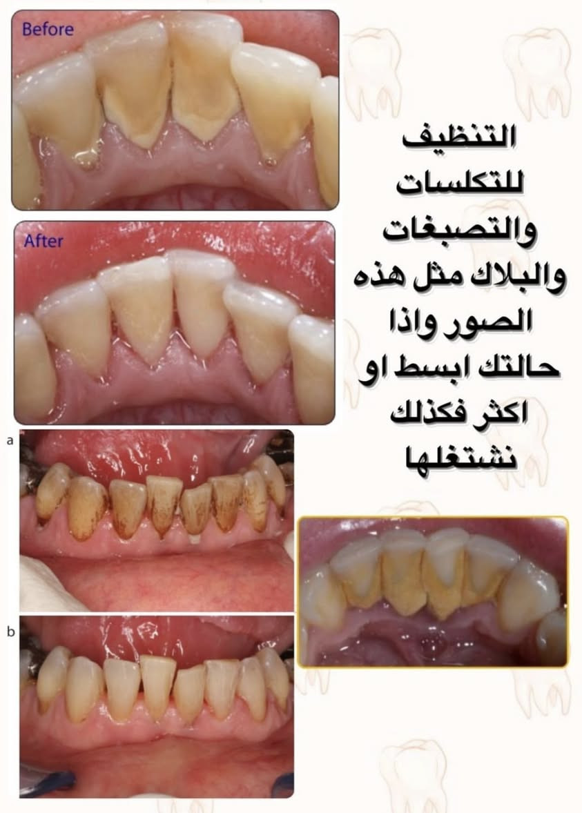 رجعنالكم بعروضنا المجانية الي ما تخلص ❤️‍🔥❤️‍🔥🔥🔥🔥
حشوات تجميلية
علاجات الاسنان للاطفال
حشوات جذور
قلع الاسنان التالفة
تنضيف التكلسات العنيدة 
طقم متحرك كامل
طقم متحرك جزئي
تعويضات فكية ثابتة
علاجات الاسنان للاطفال
كل هذذااا مجانننيييي 
سارعوا بالحجز يجماعة ولا تفوتون كل هاي العروض
الشغل يكون تحت ايد افضل الدكاترة المختصين 🔥🔥🔥🔥🔥🔥

للحجز على الماسنجر او الواتساب

***********

عيادات جامعة المنارة

