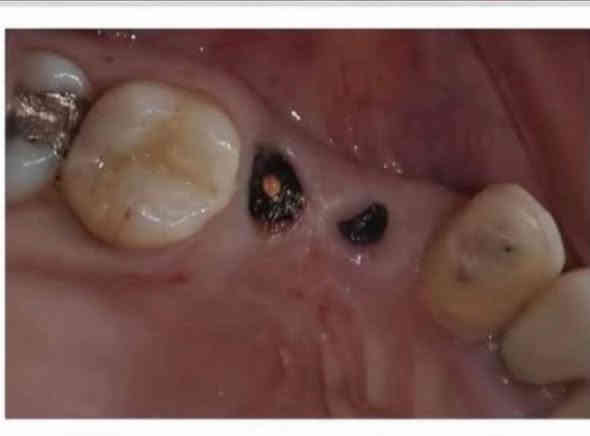 الي عندة مثل هاي الحالات ومحتاج حشوات أو قلع للاسنان والجذور المتبقية العلاج مجاني داخل عيادات جامعة واسط وبأشراف اطباء مختصين
تواصلوا وياي  عالواتساب او التليجرام 

***********
