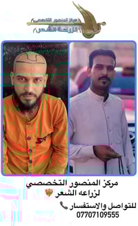 بعد سنه فقط من زراعة الشعر الفراغات اختفت والكثافة رجعت بشكل طبيعي نتي...