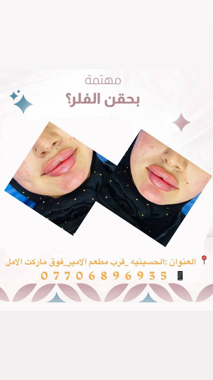 عيادة مصطفى التميمي للتجميل والليزر
لأن جمالك يستحق الأفضل 🌸
فلر _بوتكس _علاج حب الشباب _تقطيع الالياف _علاج تصبغات _سكن كير حسب نوع البشره _تنضيف بشره _ليزر
📍 الحسينية – قرب مطعم الأمير _فوق ماركت الامل _مجاور مطعم عمو باسم 
📞 ***********
عنوان الثقة والجمال الحقيقي ✨
خبرة، دقة، واهتمام بأدق التفاصيل
باستخدام أحدث الأجهزة وأفضل المواد
للحصول على نتائج طبيعية وآمنة 💎
نعتني ببشرتك حسب نوعها
ونقدّم حلول متكاملة للتجميل والعناية
جميع المواد المستخدمه داخل العياده مفحوصه وبراندات 
تنفتح كدام المراجع
