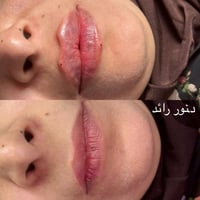 رسم شفة • د نور رائد • عيادة بيرلي