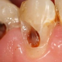 طالبة طب اسنان • قلع اسنان • طقم اسنان