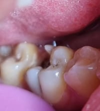 حشوة جذر • جلسة واحدة • جبله شارع الاطباء