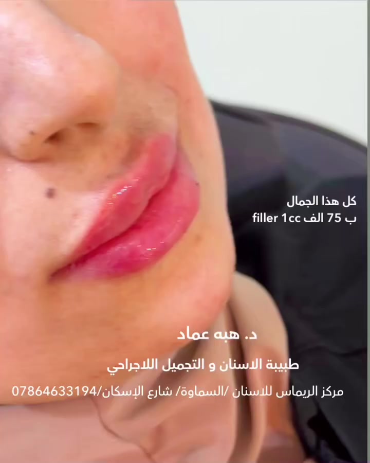 د. هبة عماد / طب الاسنان و دراسات بالتجميل اللاجراحي

•  تجميل الوجه (بوتكس-فيلر-خيوط-ميزو)
-حقن ابر نظارة و تفتيح البشرة
•  حشوات علاجية و تجميلية
-ابتسامة هوليود 
•  جراحة الفم و الاسنان
•  تنظيف و تبيض الاسنان
•  معالجات و ترميم الاسنان التالفة 
 
عيادة الدكتورة:هبه عماد

📍 السماوة - شارع الإسكان/ مركز الريماس
📞 للحجز: ***********

https://www.instagram.com/dr.heba_clinic?igsh=MXJidm01ZXk5MW4weA%3D%3D&utm_source=qr
 #الدكتوره_هبه_عماد #طب #عروض_الفيلر
