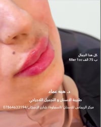 طب الاسنان • بوتكس فيلر • السماوة
