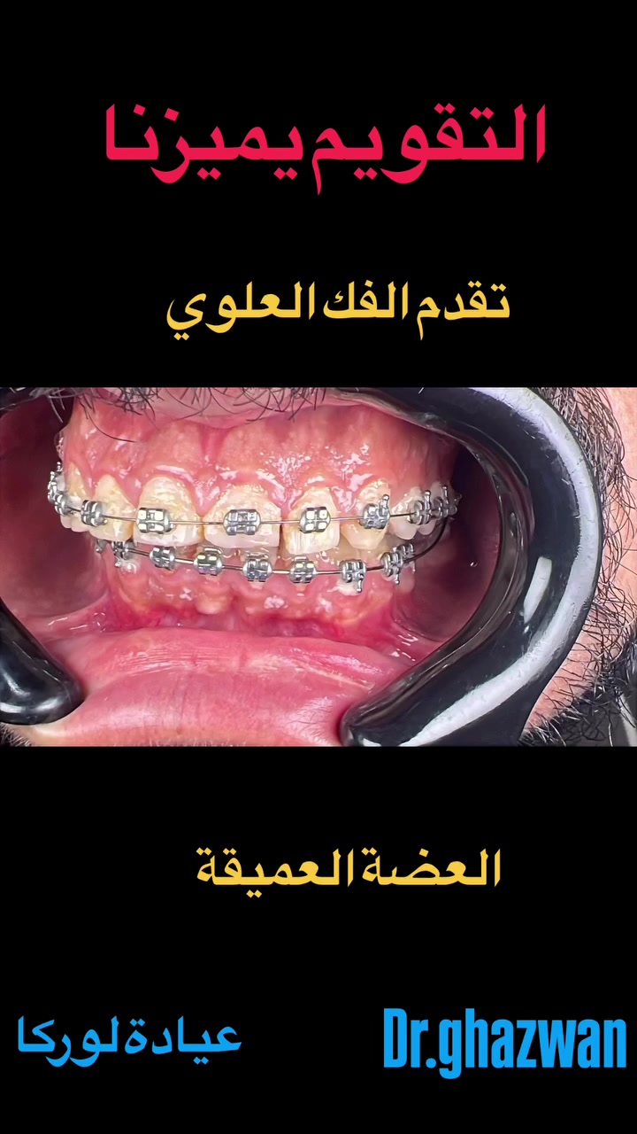 التقويم يميزنا احد اعقد و اصعب الحالات تقدم الفك العلوي وعدم انتظام الأطباق يعاني من مظهر خارجي غير متناسق و عدم القدرة على قطع الطعام و الكلام و تجمع للبكتريا و الترسبات الطعام في بعض الأماكن عدم القدرة على التنظيف بشكل طبيعي… علاج جميع الحالات الصعبة و المستعصية نتائج مضمونة ابداع في مظهر الخارجي للاسنان. شكل مثالي للأسنان نتائج جميلة جدا… دكتور غزوان مزهر بغداد الكرخ نفق الشرطة بداية شارع الاطباء عيادة لوركا فوق صيدلية كنز النفق متوفر واتس *********** #تقويم_الأسنان_والفكين #تقويمالأسنان #تقويم_الأسنان_بأنواعه #تقويم_الشفاف_للأسنان #تقويم_الأسنان_قبل_وبعد @تقويم_الاسنان @تقدم_الفك_السفلي @العضة_المعكوسة @العضة_المفتوحة @العضة_العميقة
