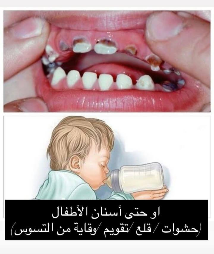 السلام عليكم 
اللي يحتاج علاج يخص أسنان الأطفال
(فحص، تنظيف، حشوات، قلع أسنان لبنية، تطبيق مادة الفلورايد للحماية من التسوس ، علاج آلام الأسنان، والمتابعة الدورية)
يتواصل وياية حتى أحجز له موعد
📍 في المستشفى التعليمي – جامعة الكوفة
📩 للتواصل عبر حساب الفيسبوك
📱 أو واتس آب: ***********
