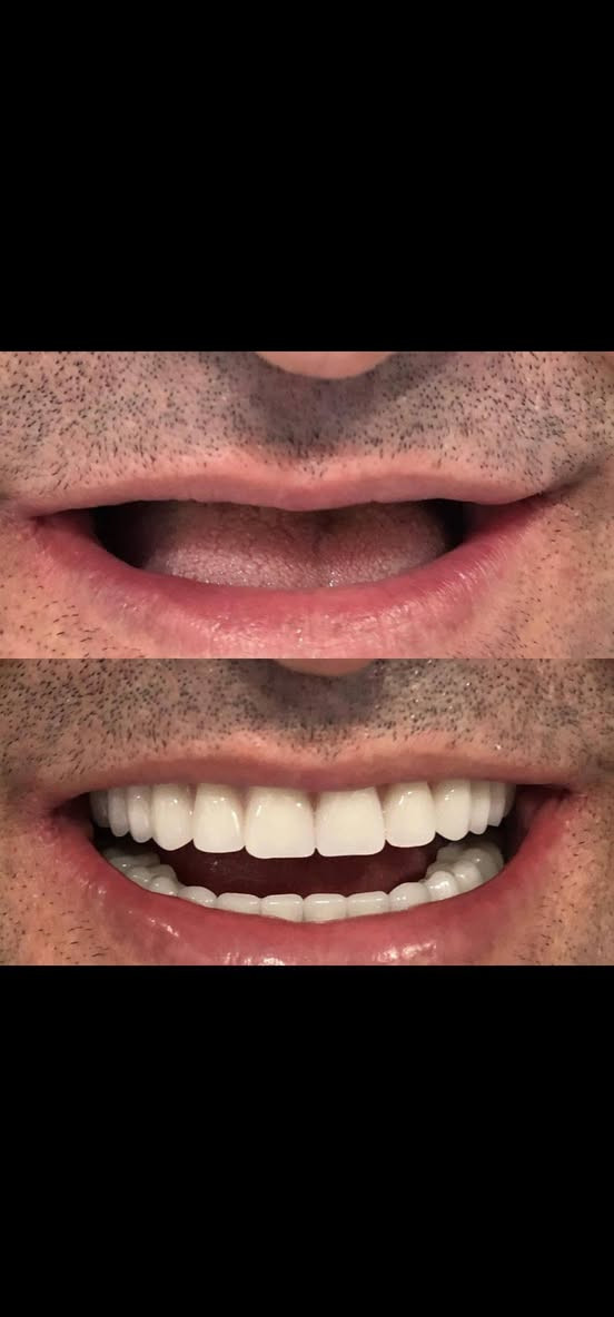 نعلن عن استقبالنا وبشكل مجاني وتقديم الخدمات الطبيه وبإشراف اطباء مختصين للحالات التأليه :
•تعويض الاسنان المفقوده بشكل كامل بطقم اسنان متحرك 
•حشوات ضوئيه دائميه للأسنان 
•قلع الاسنان التالفه وبقايا الجذور 
التواصل يكون عن طريق الخاص او الرقم 
+964 773 603 8733
العنوان / بابل / عيادات جامعة المستقبل طب الاسنان
