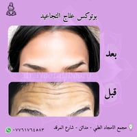 بوتوكس • تجاعيد الجبين • د نور الجبوري