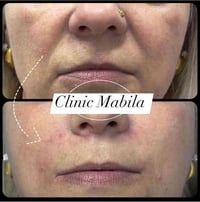 حقن فلر • الخطوط الضاحكة • خانقين