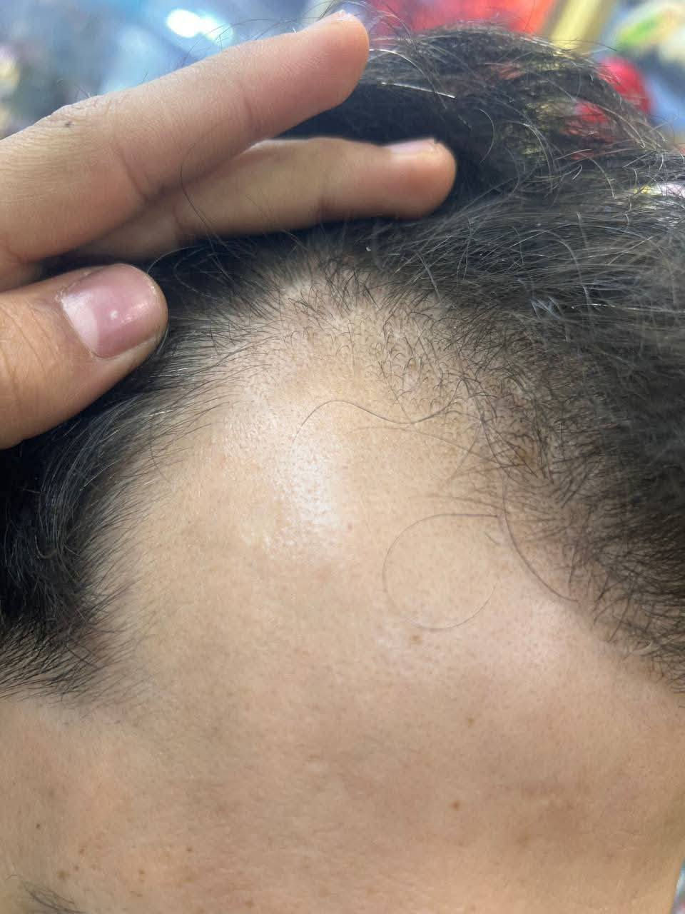 ماڵئاوایی لە قژ هەڵوەرین بکە و قژت پڕ بکەرەوە!
بە نرخی تاک کۆ هەیە 
​ئەگەر بەدەست تەنکبوونی قژ یان هەڵوەرینی بەردەوامەوە دەناڵێنیت، سێرەمی Aichun Beauty 8-in-1 چارەسەرە ڕاستەقینەکەیە. ئەم سێرەمە بەوە ناسراوە کە لە ماوەیەکی کورتدا ئەنجامی دیار دەبەخشێت.
​✨ سوودە سەرەکییەکانی:
​ڕاگرتنی هەڵوەرین: لە یەکەم هەفتەکانی بەکارهێنانەوە هەستی پێ دەکەیت.
​ڕواندنەوەی قژ: یارمەتی پڕکردنەوەی جێگایە چۆڵەکان دەدات.
​بەهێزکردنی تاڵەکان: قژ لە ڕەگەوە بەهێز و ئەستوور دەکات.
​بۆ خانمان و پیاوان: گونجاوە بۆ هەموو جۆرە قژێک.
​🛑 الحل النهائي لتساقط الشعر وفراغات الرأس!
​إذا كنت تبحث عن كثافة حقيقية وإيقاف فوري لتساقط الشعر، سيروم Aichun Beauty هو اختيارك الأفضل بتركيبته المتطورة.
​✨ المميزات:
​إيقاف التساقط: تلاحظ الفرق من الأسابيع الأولى.
​إنبات الشعر: يساعد في ملء الفراغات وتحفيز البصيلات.
​تقوية الجذور: يجعل خصلات الشعر أقوى وأكثر حيوية.
​للجنسين: تركيبة فعالة تناسب الرجال والنساء.
​📥 بۆ داواکردن و زانیاری زیاتر پەیوەندی بکەن بە:
​📞 ***********
📞 ***********
#قژ #قژ_هەڵوەرین #تەندروستی_قژ #جوانی #سێرەم #کوردستان #سلێمانی #هەولێر #کەرکوک #دهۆک #چارەسەر #تساقط_الشعر #عناية_بالشعر #سيروم #جمال #العراق #بغداد #اربيل #سليمانية #AichunBeauty #HairCare #HairGrowth #AntiHairLoss #BeautyTips #NaturalHair
