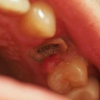 قلع أسنان مجاني • بقايا جذور • جامعة الموصل