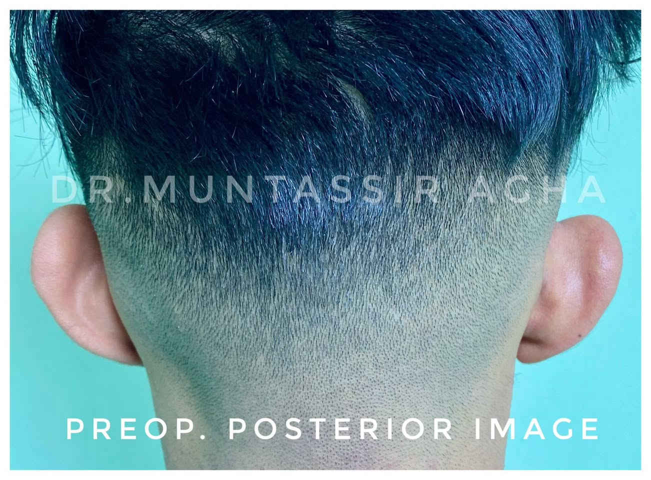 ما شاء الله… عملٌ مشرّف يرفع الرأس
للدكتور منتصر طه فتّاح آغا

تصحيح بروز صيوان الأذن
باستخدام أحدث التقنيات الجراحية المعتمدة علميًا،
لتحقيق مظهرٍ طبيعي متناغم مع ملامح الوجه.

الدكتور منتصر طه فتّاح آغا
اختصاص جراحة الوجه والفكين
وزراعة الأسنان

🔹 تخطيط جراحي دقيق
🔹 نتائج مستقرة وطبيعية
🔹 أمان طبي عالٍ
🔹 رعاية طبية متكاملة وفق أحدث المعايير الطبية

📍 العنوان: الحلة – حي الإمام – مجمع الوافي الطبي
📞 للحجز والاستفسار: ***********
