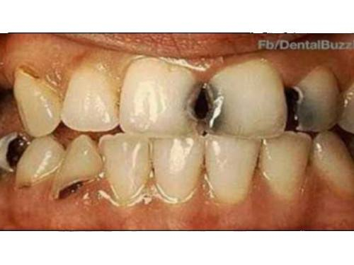 السلام عليكم 
حشوات امامية مجانا للاسنان مكسورة او متسوسة 
مكان شارع فلسطين جامعة المصطفى تواصل خاص او واتساب على رقم ***********
