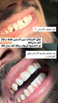✨ عروض العيد بعدنا مستمرة وما راح تتكرر 🔥🦷  جلسة غلق فراغات بسعر مو مو...