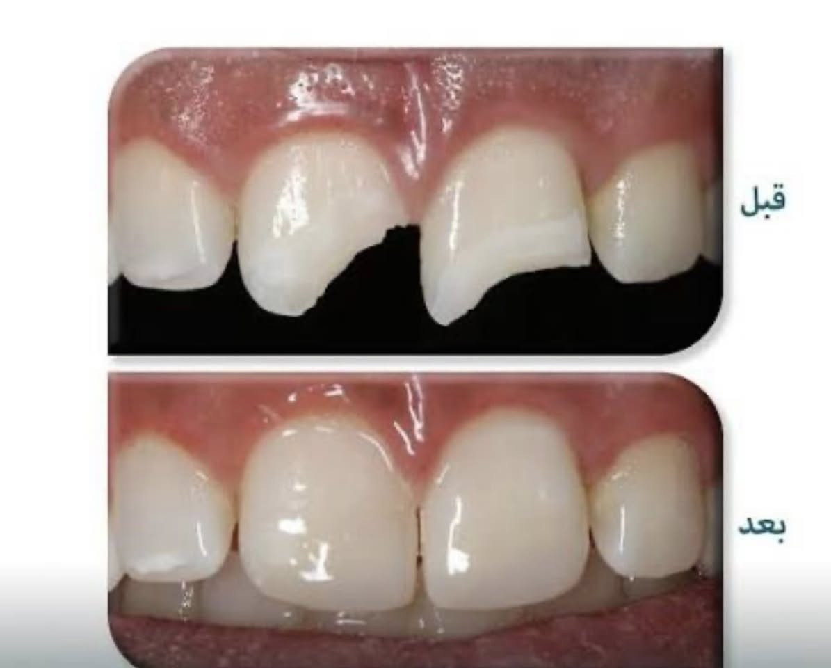 سلام عليكم (((((((العلاج المجاني))))))
اي شخص عنده حالات(تسوس،قلع، تنظيف، طقم اسنان)
يراسلني خاص وعلاج مجاني!!!!!
في عيادات اوروك في منطقة الكراده شارع ٥٢
للتواصل ع ماسنجر او الرقم التالي
 ***********
