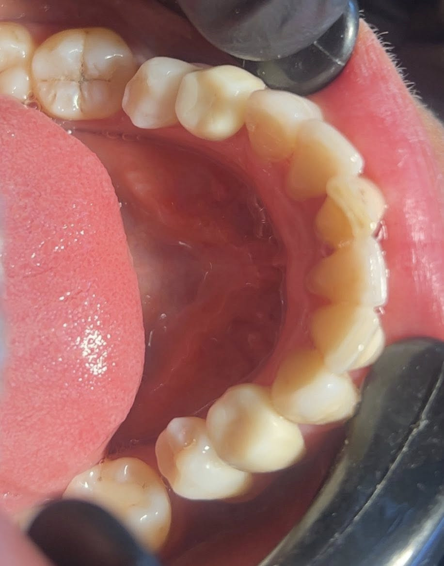 حافظ على أسنانك المكسوره
وغلفهم بتركيب زاركون بقوة المعدن
ضمان لمدة عشرين سنه
بالعرض حاليا سعره ٧٥ بدل ١٠٠ الف 
هذا العرض ساري لفتره محدوده

للحجز ***********
عيادة البيت الطبي المحمودية حي الموظفين مقابل التانكي
