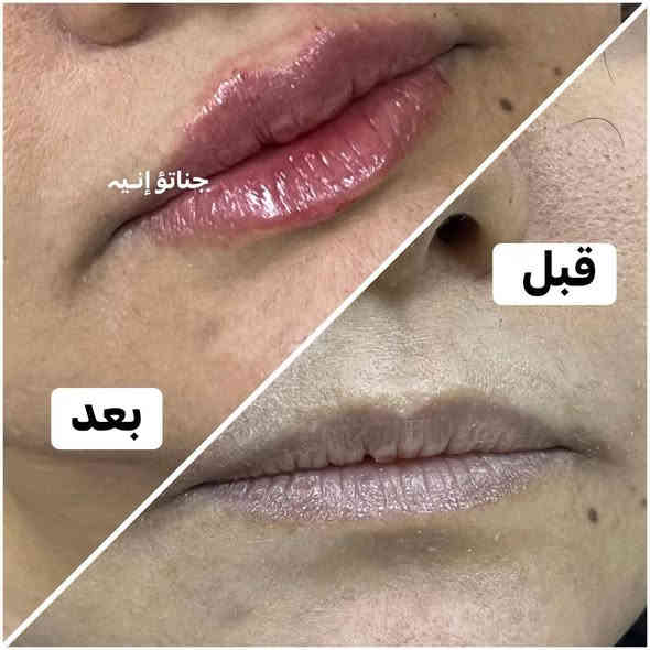 عروض كرسمس ،🎆🎀🎆
حفافة فقط 8

تنظيف بشرة 10بجهاز الهايدوفشل 

حفافة مع تنظيف بشرة بجهاز الهايدوفشل 15

المجموع قبل العرض 28

العرض صار المجموع 15
 

دللي نفسج وبسعر 15فقط 
حفافة مع تنظيف بشرة  كل هذا بسعر 15
صبغ الشعر القصير جداٍ بسعر 15 
الوسط 15
الطويل 25 

صبغ وميش للشعر القصير 35
فقط ميش 25
صبغ وميش للشعر الوسط 50
فقط ميش 35
صبغ وميش للشعر الطويل 65
فقط ميش 50

دكتورة رصابرين خبيره تجميل
عرض اول مره يصير حصري يمنا 
 
فلر كوري براند السعر السابق 150
السعر حالين سيسي واحد ب50
عرض يجنن ستغلو العرض ميتكرر

العرض ينتهي يوم 1/1

العنوان.  كربلاء قنطرة السلام
صالون الروان

💜أهلا وسهلا  ) 

الحجز وتساب ***********
H .M c🪻🪻🪻🪻🪻🪻🪻🪻🪻🪻🪻🪻🪻#عيادات_تجميل #اطباء #مراكز_تجميل #مخدر_موضعي #فلر #ميزوات #بلازما_البشرة #طبيبات_جلدية  #بغداد_العراق #صالونات #ميزو #فلر #ميزو_فلر #مراكزتجميل #عيادات_تجميل #اطباء #صالونات #بغداد_العراق #مستحضرات_تجميلية#بوتوكس #ميزو #بشره #جلد #جمال #فلرات #شفاه
@إشارة
