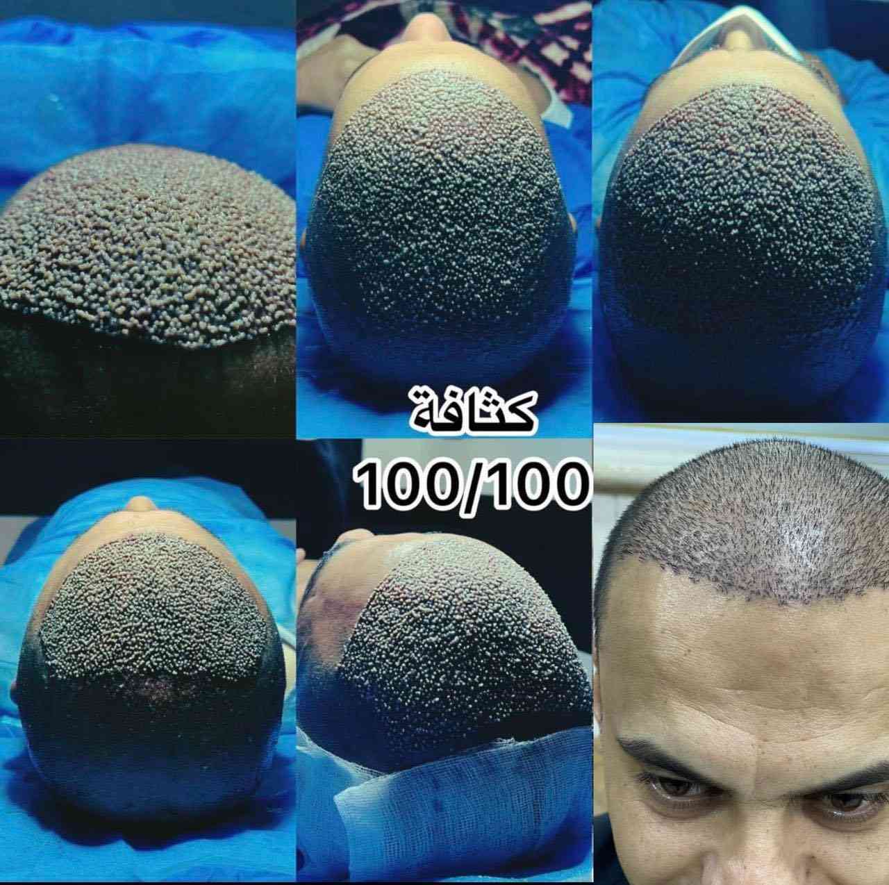 ملاحظة مهمّة جدًا 👇
قبل لا ينسرق الكلام من قبل المراكز
ويبدون يحچون بنفس الطريقة ونفس الصيغة

مركز المتخصص
هو المركز الوحيد
اللي يشرح كافة التفاصيل
قبل الزراعة وبعد الزراعة 🫵🔥👌

انتبه زين
قبل لا تتخذ القرار النهائي 👇

⸻

خطة زراعة الشعر مضمونة
على يد الطبيب المختص
شغل دقيق
يقلّل نسبة الخطأ إلى أدنى حد

المركز يتحمّل مسؤولية أي خطأ
أمّا نجاح العملية
فيعتمد على خبرة المختص
الذي يقوم بقطف البصيلات
بدقّة عالية جدًا

كما تعتمد النتيجة على
غرز البصيلات في المكان الصحيح
بعد فتح القنوات
بزاوية واتجاه صحيحين
وبما يتوافق مع اتجاه الشعر القديم

وتعتمد مرونة ومظهر الشعر
على عمق فتح القنوات
وبقياسات هندسية دقيقة
مدروسة بعناية
من قبل المختص

⸻

VIP اختيارك المفضّل

📞 واتساب للحجز:
***********

📞 الإدارة (واتساب):
***********

📞 واتساب للحجز:
***********
