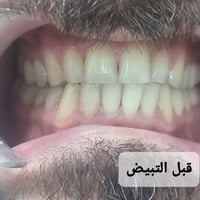 ✨ عروض العيد لتعديل الابتسامة ✨ عيادة دكتوره الدكتورة هند الحسيني  خلي...