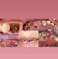 قلع اسنان • جذور اسنان • مجاني