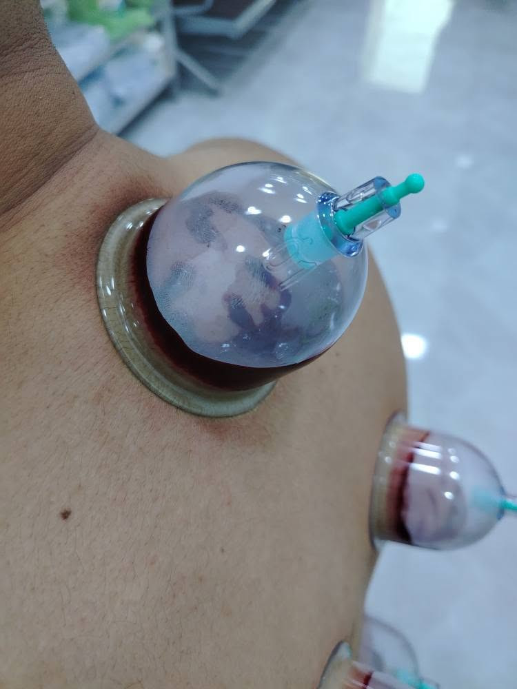 يتكون دم الحجامة (المستخرج عبر الحجامة ) من سوائل وتركيبات تختلف عن الدم الوريدي العادي.
 يحتوي في الغالب على كريات دم حمراء هرمة، ونسبة عالية من السموم والمعادن الثقيلة، إضافة إلى أخلاط وترسبات ضارة تسعى الحجامة لإخراجها من الجسم.إليك التفاصيل العلمية لمكونات هذا الدم وخصائصه:كريات الدم الحمراء: يتركز في دم الحجامة عدد كبير من كريات الدم الحمراء التالفة أو "الهرمة" التي انتهى عمرها الافتراضي وتكون محملة بالشوائب مختصة هذا ما وجده العلماء في الدم المستخرج بعد الحجامة  كما يحمل نسبة هيموغلوبين مركزة.السموم ومخلفات الأيض: أثبتت الأبحاث أن دماء الحجامة تحتوي على مستويات أعلى بكثير من السموم، مثل حمض اليوريك، والأمونيا، واليوريا مختصة هذا ما وجده العلماء في الدم المستخرج بعد الحجامة والتي قد تصل لسبعة أضعاف الحد الطبيعي الموجود في الدم الوريدي.المعادن الثقيلة: يساعد هذا الإجراء في التخلص من المعادن الثقيلة والضارة المترسبة في الأنسجة، وتخفيف مستويات بعضها (مثل الكادميوم والألومنيوم) في الجسم تأثير العلاج بالحجامة الرطبة على مستويات بعض المعادن الثقيلة في الدم.خلايا الدم البيضاء: يلاحظ أن نسبة خلايا الدم البيضاء في دم الحجامة أقل بكثير منها في الدم الطبيعي، مما يعني توفير حماية أكبر للخلايا المناعية لتبقى نشطة وتعمل بكفاءة داخل الجسم مختصة هذا ما وجده العلماء في الدم المستخرج بعد الحجامة الرمادي, الأنبار


**إذا كنت صاحب هذا الإعلان وتريد حذفه لأي سبب، رجاءا أرسل رسالة إلى الدعم الفني**