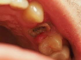 السلام عليكم منشور للفائده الي عنده جذور او اسنان تحتاج قلع ، او سن العقل جراحيا  يراسلني 
( العمل مجاني فقط باجر اخر عياده ) 

📍الحله شارع ٤٠ مجاور صيدليه سلامتك اولا 
واتساب ***********
