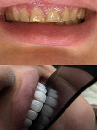 إيماكس • تجميل أسنان • البصرة المطيحة