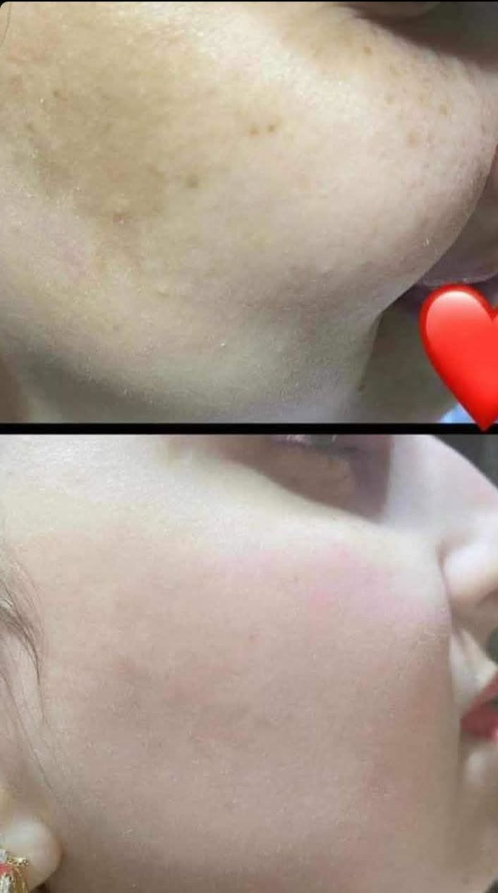 صباح الخير بنات 
ليوم سويتلكم عرض يفوتكم 
صابونه وكريم لكل مشاكل البشره ومقشر للبشره وزيت لشعر سعر بس 15 الف يعني هيج عرض وهيج سعر وشغلها زين ماتلكين وداعتي 
تعالن خلي اشرحلجن شيسون هذا البكج 
الكريم مو كريم عادي يعالج تصبغات شكد ماجانت قويه سواء من شمس من حمل يعالجها يخفف الكلف وشوطات الي تصير بالوجه يعالج المسامات الواسعه ومصير تعصروها تزيد عليكم يعني كريم براسه 60حظ 
الصابونه وما اداراك ماصابونه 🤣
تنضف بعمق ورغوه قويه تعالج حب شباب البشره دهنيه تبيض سريع وتشيل تصبغات 
المقشر قبل الاستخدام لكلشي لازم نسوي حتى تنضف بشره ويصير توب 
زيت شعر يعالج قشره وتساقط وتقصف ويملي فراغات من اول سبوع تشوفين فرق مو طبيعي 
امانه الله مو لان شغلي وامدح بي انتن كلجن خواتي انشاءالله ونصيحتي الكم تجربو وتشوفون النتائج شكد زينه ومتذبون فلوسكم على مواد كمياويه غاليه وتحرك الوجه بالزايد بيناتنه الله واهل بيت اي وحده تجربه ومتشوف نتيجه تراسلني امانه الله عليها ميهون عليه اوكل جهالي بربع دينار حرام ماطول عليكم طريقه استخدام ع خاص تراسلوني وشغله ثانيه حسوي مسابقه الي تسوي تاكات وتعلق اكثر وحده الها البكج مجاني والف عافيه لعرض ليومين فقط


**إذا كنت صاحب هذا الإعلان وتريد حذفه لأي سبب، رجاءا أرسل رسالة إلى الدعم الفني**