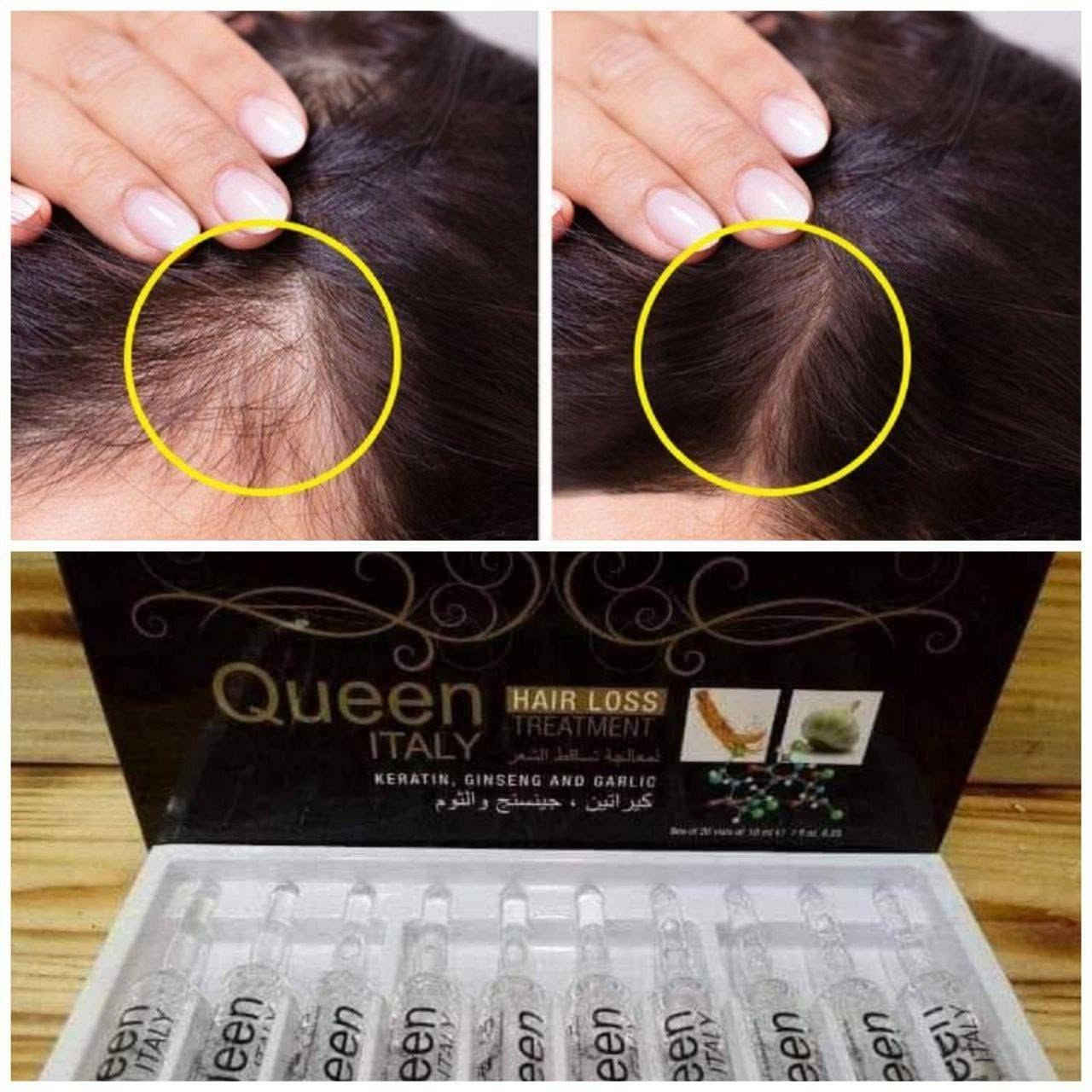 واخيراا توفرت بعد طول انتظارر👍
أفضل علاج لتساقط الشعر 
بكج امبولات كوين لتساقط شعر 
#الأصلية 💯💯الايطالية💯💯
لكثرة الطلب عليها وكثرة التجارب الرائعة في وقف التساقط وفرناها لكم مرة اخرى

بكج امبولات علاج تساقط الشعر وبطأ النمو والتقصف وضعف بصيلات الشعر امبولات كوين الايطاليه لوقف لتساقط الشعر وتعالج ضعفه أبر كوين مصنوعة من الكرياتين و جينسنج والثوم اعشاب طبيعية معالجه مضمونه للتساقط والتقصف وينظم عمل الغدد الدهنية بالاضافة الى تكييف فروة الرأس ومنع عملية ترقق وضعف الشعر ويساعد على نمو الشعر 

1- تغذي بصيلات الشعر و تعيد نشاطها وحيويتها 
2- تمنع التساقط الشعر حتى الوراثي نهائياً 
3- تقوي الشعر وتعيد كثافه الشعر 
.. 
الاستعمال 
الامبولات ليست حقن استعمال خارجي فقط
1 - نغسل الشعر شامبو ضد التساقط او مغذي و يجفف..
2- نفتح الامبوله و نضعها ع الشعر و ندلك لمدة 5 دقائق بالراس..
3- تترك ع الراس 6 ساعات و بعد يغسل الشعر او لايغسل ..
4- كل 3 ايام نستخدم ابرة واحده
يحتوي السيت على ٢٠ امبوله

-منتج اصلي مضمون ومجرب
الصناعه ايطالي 🇮🇹💯
المنتج أصلي 💯💯 موصل, نينوى


**إذا كنت صاحب هذا الإعلان وتريد حذفه لأي سبب، رجاءا أرسل رسالة إلى الدعم الفني**