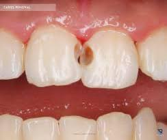 شباب اي شخص عندة مثل هاي الحالات نكدر نشتغله حشوات تجميليه وبافضل المواد
وبشكل مجاني ( العلاج مجاني )

الموقع✨

كربلاء/ طريق الحر الصغير 

جامعة اهل البيت 

لتواصل واتساب …📞

***********
