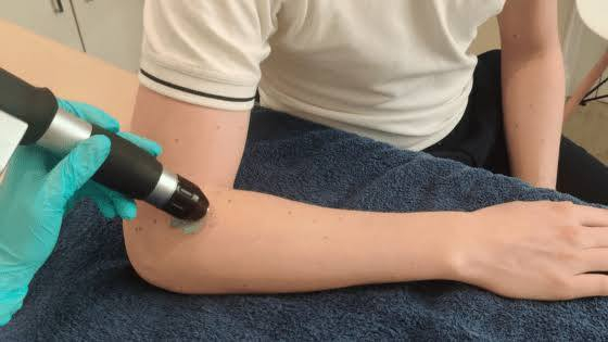 مرفق التنس" (Tennis Elbow) 

هو حالة طبية مؤلمة تُعرف طبيًا بـ "التهاب اللقيمة الجانبية" وتنتج عن الإفراط في استخدام عضلات الساعد، مما يسبب التهابًا أو تمزقًا في الأوتار التي تربط هذه العضلات بالجزء الخارجي للمرفق، وتظهر الأعراض كألم يمتد من المرفق للساعد وقد يسبب ضعفًا، ويصيب الرياضيين وغير الرياضيين بسبب الحركات المتكررة، وتُعالج بالراحة، الأدوية، العلاج الطبيعي، وقد تصل للحقن أو الجراحة. 

✅الأسباب
🔴الإفراط في الاستخدام: حركات اليد والرسغ المتكررة (مثل حمل الأشياء أو استخدام الأدوات).
🔴المهن: السباكون، النجارون، الطهاة، الجزارون، الرسامون.
🔴الأنشطة: رياضات المضرب (التنس، الجولف)، التجديف، العزف على الآلات. 

✅الأعراض
🔴ألم ووخز حول الجزء العظمي الخارجي للمرفق.
🔴امتداد الألم إلى الساعد والمعصم.
🔴ضعف في قبضة اليد.
🔴بداية تدريجية للألم. 

✅✅العلاج (غير جراحي)
🟠الراحة: تجنب الأنشطة المجهدة لأسابيع.
🟠الأدوية: مسكنات الألم ومضادات الالتهاب (مثل الإيبوبروفين).
🟠العلاج الطبيعي: يعتبر من افضل الطرق الآمنة والفعالة في علاج الحالة المزمنة وذلك عن طريق جهاز الموجات الصدمية وكذلك جهاز الموجات فوق الصوتية
🟠الدعامات: رباط للساعد لتخفيف الضغط على الأوتار.

علاجات أخرى
🟠حقن الكورتيكوستيرويد (موضعية): قد تُستخدم لكن فعاليتها محل جدل.

🟠البلازما الغنية بالصفائح الدموية (PRP): حقن عوامل النمو من دم المريض للمنطقة المصابة.

🔴🔴🔴الجراحة: في الحالات الشديدة التي لا تستجيب للعلاج.

العنوان
بغداد 
الأمين2 
شارع النواب مقابل كراج سوق الشهداء 
***********
