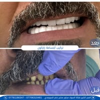 تركيب زيركون • عيادات الطيف • المجر الكبير